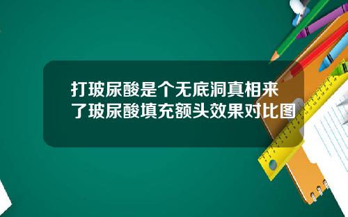 打玻尿酸是个无底洞真相来了玻尿酸填充额头效果对比图